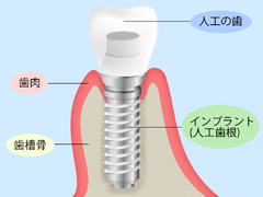 自分の歯のような見た目と噛み心地～インプラント～