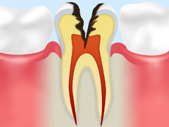 C3～神経に達した虫歯～