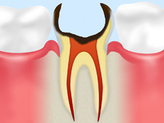 C4～歯根に達した虫歯～